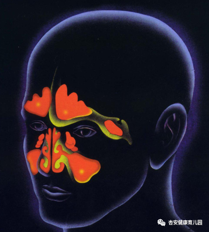 鼻窦黏膜炎症性疾病统称为鼻窦炎,是鼻科中最常见疾病.