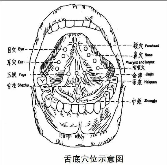 中风后吞咽困难只知道舌三针和点刺舌头其实另一个部位也很重要