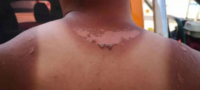 王治勇的后背被晒脱皮(图源:受访者供图)