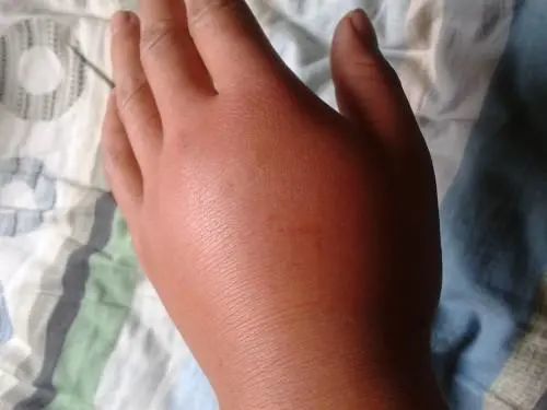 可反复蜇人;被蜜蜂蜇伤只是皮肤红肿热痛;而被黄蜂蜇伤会伴有全身症状