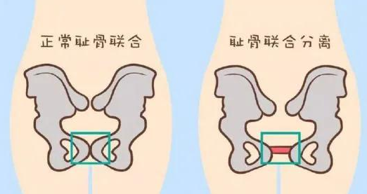 耻骨疼痛是什么原因引起的 腾讯新闻