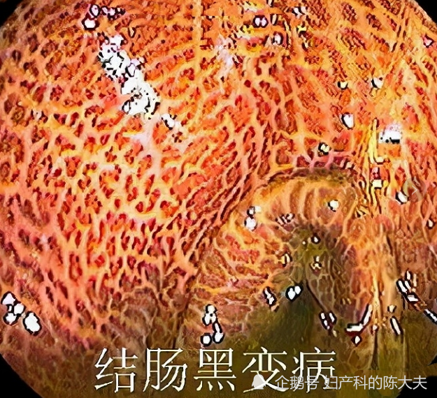 这位阿姨得的是结肠黑变病,主要由蒽醌类泻药引发.