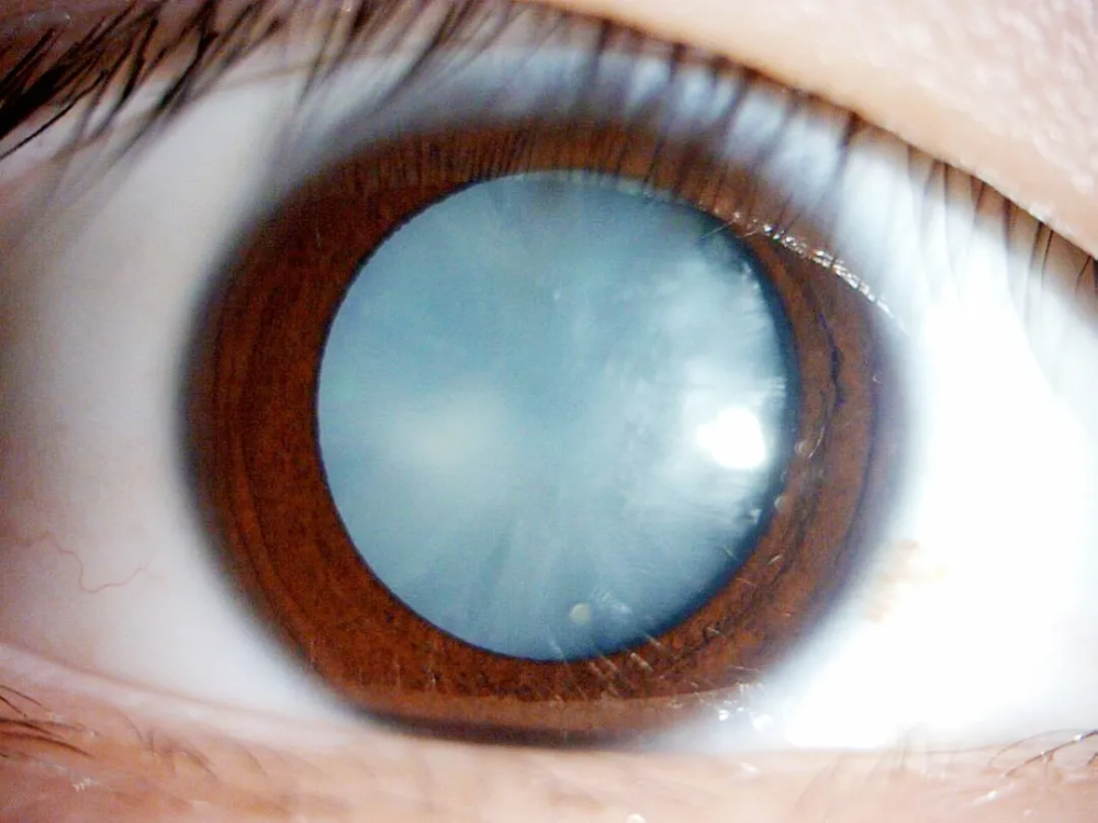 甜到哀伤!15岁男孩喝可乐喝出白内障,右眼几乎完全失明