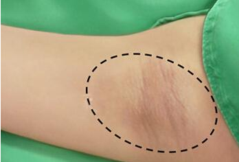 為什麼不建議做腋臭手術呢