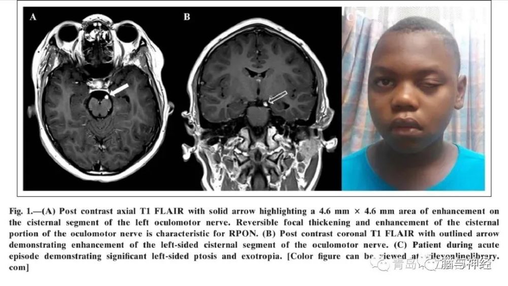 鉴别诊断tolosa-hunt 综合征(tts):头痛 眼肌麻痹,这组症状需要鉴别的