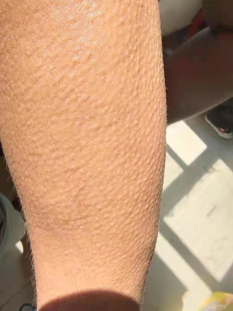 脱水皮肤会起鸡皮疙瘩(皮肤上长像鸡皮疙瘩还脱皮)