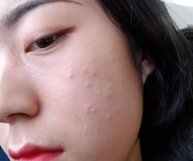 长春肤康医院浅谈:长痘痘该怎么办?这些方法可以帮助你