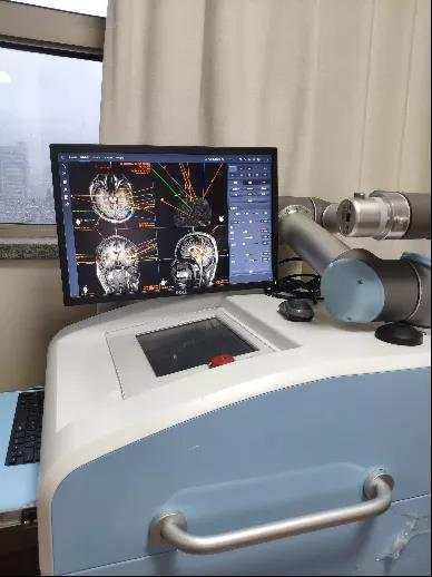 了诊疗计划,为了精准定位致痫灶,需要关掉dbs并在脑深部植入监测电极