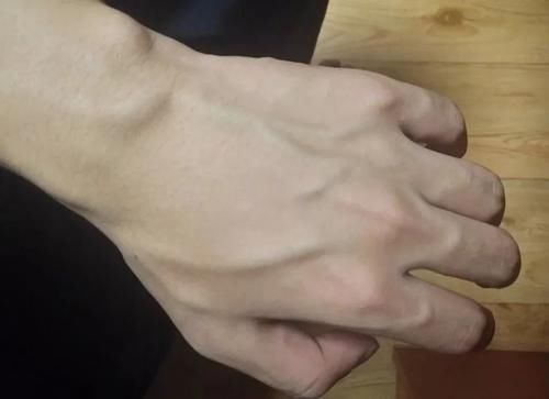 手上青筋增多,一般是什么原因所致?该如何预防