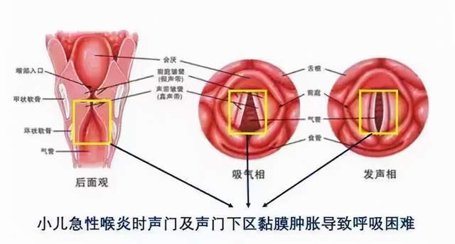 咳嗽等,初起声音嘶哑大多不严重,哭闹时有喘声,继而炎症侵及声门下区