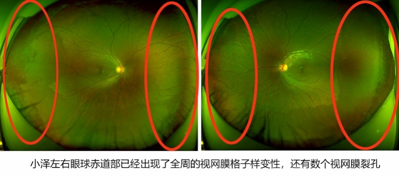 8岁近视900度还有视网膜裂孔手机偏方差点致他失明