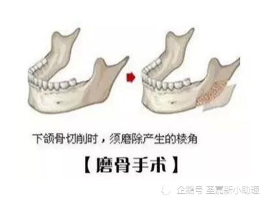 頜面醫生邱立東磨骨手術貴嗎需要多少錢