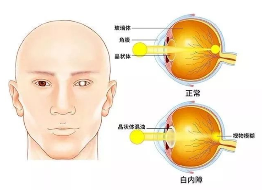 鄭說健康第四十期全面認識白內障遠離治療誤區