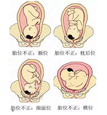 胎位不正需要注意什么