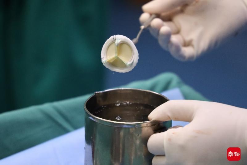 通过导管技术在原有不能工作的生物瓣里面再次植入一个新的支架瓣膜