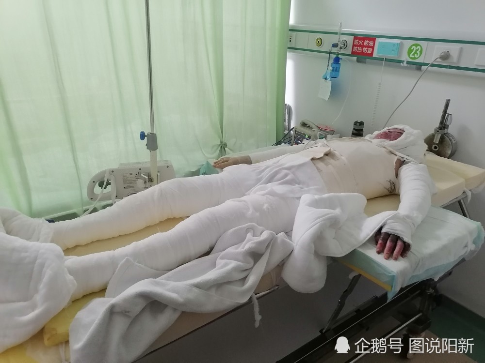 刘继红伤情严重,全身70%被煤气火焰烧伤2-3度,烧伤性休克,被告病危.