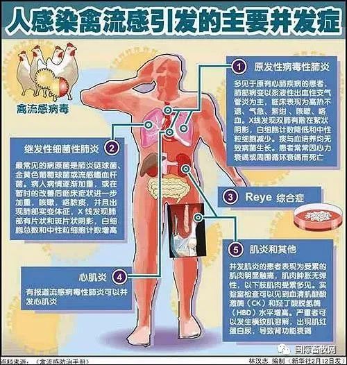 又一例广东东莞出现人感染h5n6禽流感病例