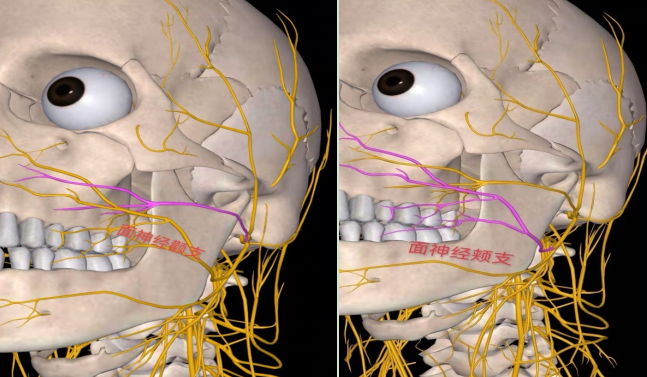 綜上:根據面神經的分佈特點及功能特點,一旦面神經受病毒,寒涼等刺激