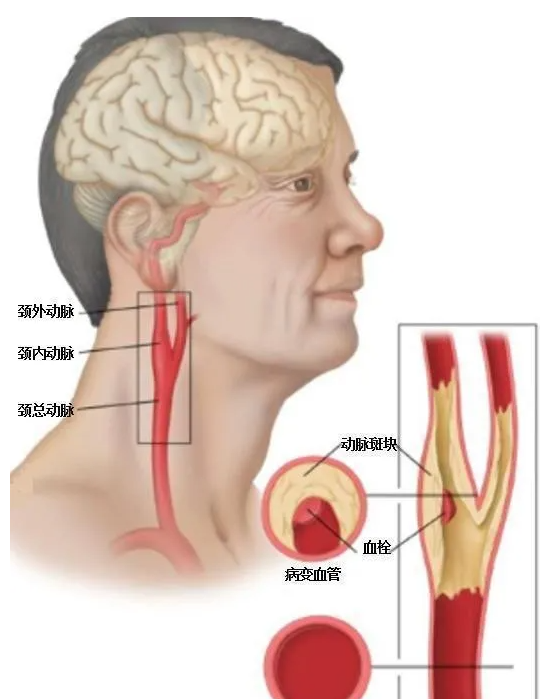 体检发现颈动脉斑块这是啥要治吗