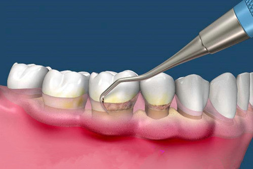 牙周炎是什麼原因引起的?口腔師總結預防和治療根源