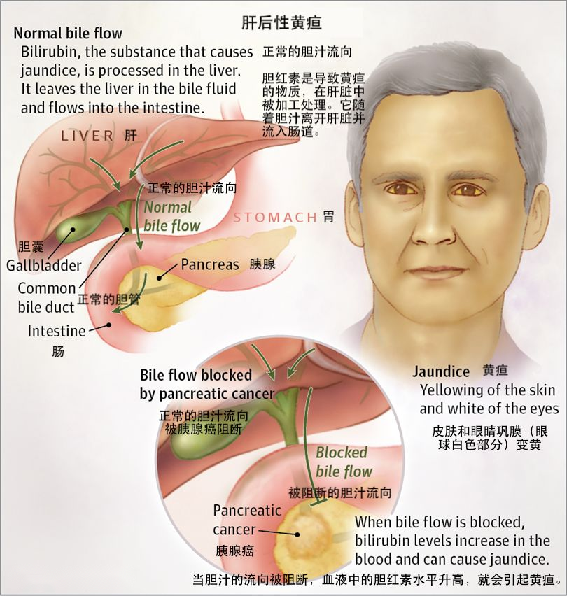 恶性梗阻性黄疸的护理