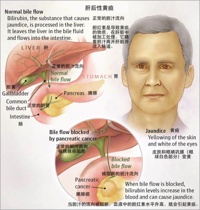 肝外膽管引流系統,導致血清膽紅素升高,皮膚,鞏膜黃染,皮膚瘙癢,膽道