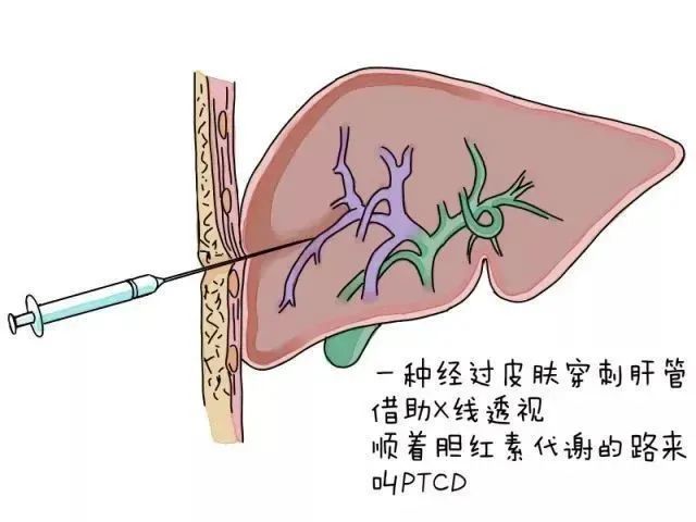 穿刺導管留置在梗阻上游的膽管內作引流,又稱經皮肝穿刺膽道置管引流