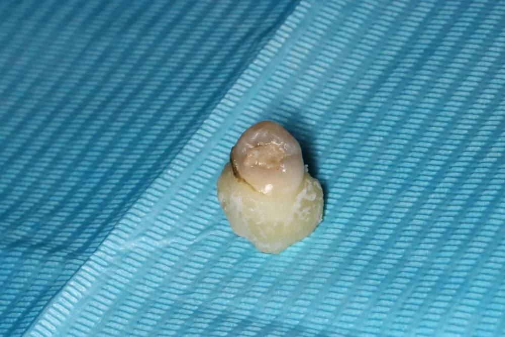 别人拔智齿只要几百块我拔智齿却很贵是我被坑了吗