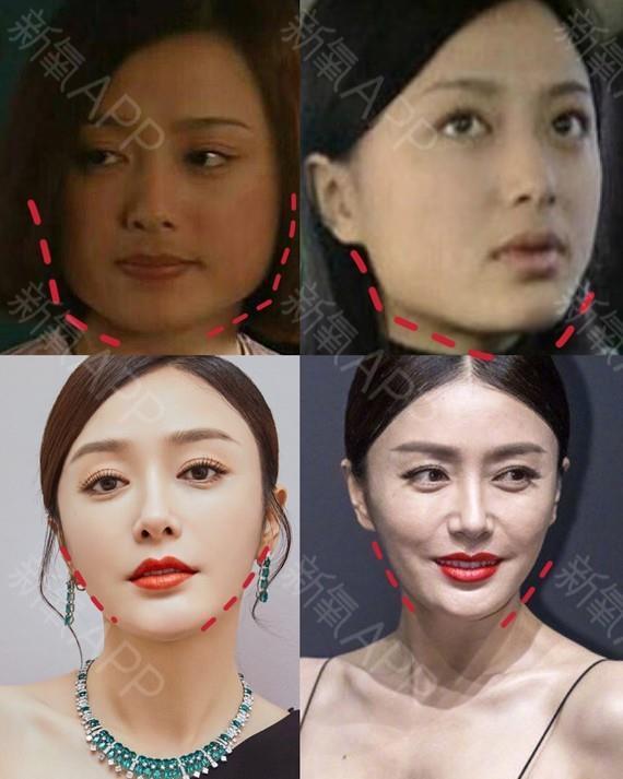 削骨的明星后悔了吗?后遗症一大堆,小方脸反倒成了真香系列!_腾讯新闻