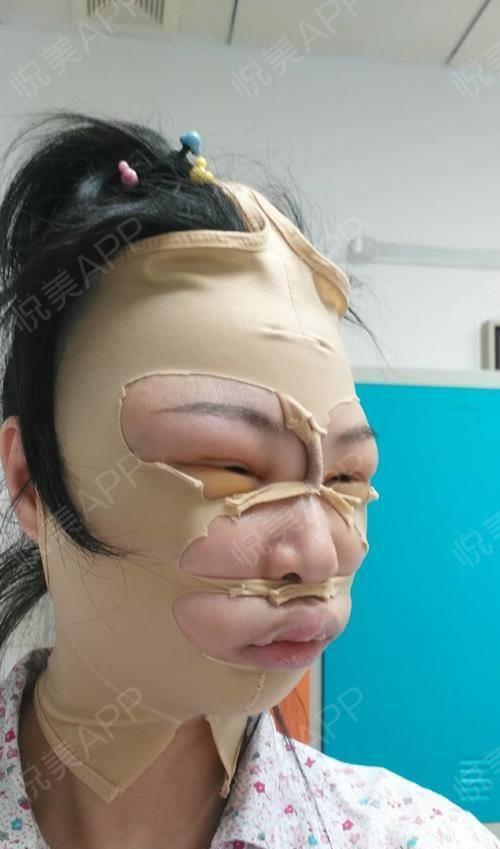 削骨的明星后悔了吗?后遗症一大堆,小方脸反倒成了真香系列!_腾讯新闻