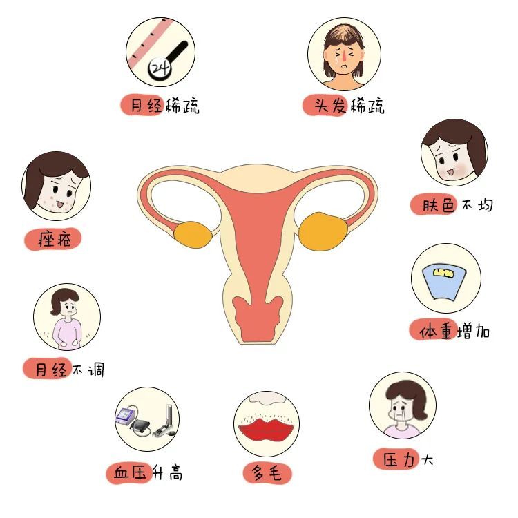 月经失调 肥胖 痤疮 不孕 你的卵巢周围有一条项链吗 腾讯新闻