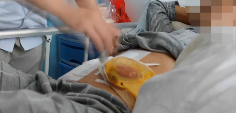 开玩笑男子被高压气枪对准肛门充气险身死高压气枪威力有多大