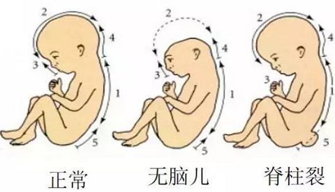 贝安健康:无脑儿和染色体有关系吗?