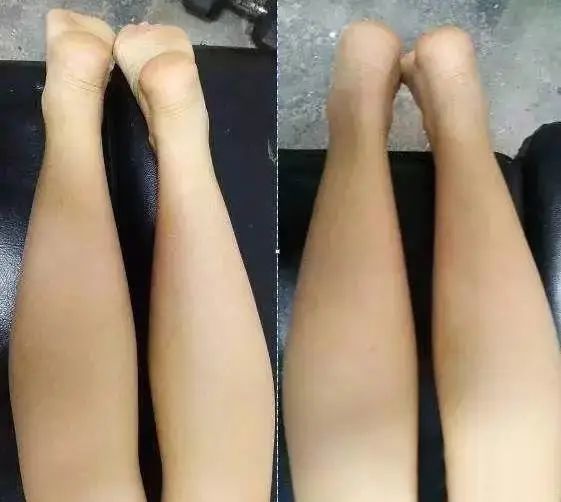 长短腿是怎么产生的