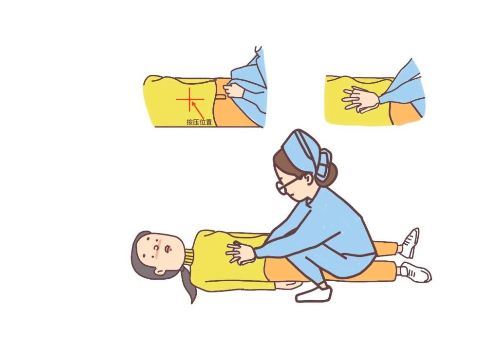 三 孕妇急救患者站立,两手轻抚腹部,抢救者站在患者背后,用两手臂环绕