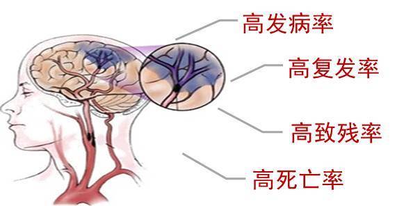 秋季腦梗死發病率那麼高,是什麼原因呢?這兩點您知道嗎?