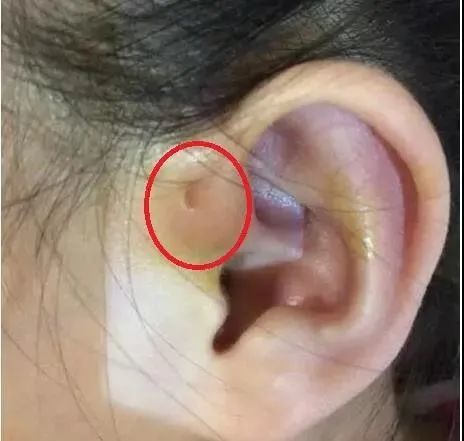 杭州10岁女孩耳朵上有个"富贵仓",却因此挨了一刀