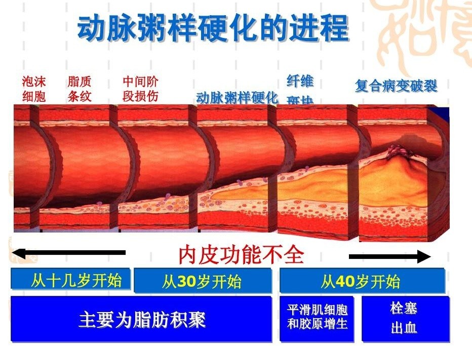 預防動脈粥樣硬化性心血管疾病如何合理使用他汀