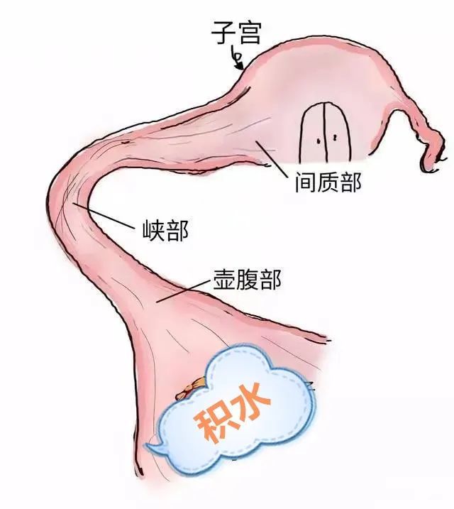 输卵管积水的应对策略