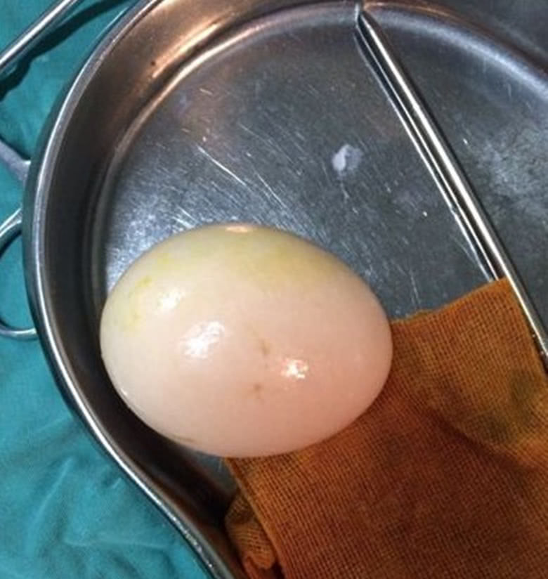 医生成功取出肛门异物结果患者以未做整个肠镜拒绝付钱