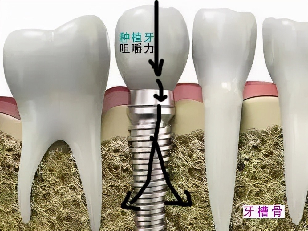 牙齒缺失後陷入鑲牙or種牙之間難以抉擇良心牙醫告訴你怎麼選