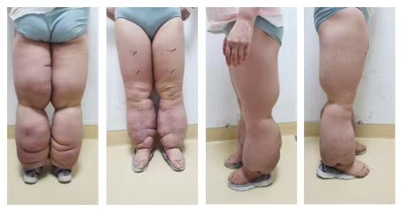 大姐宫颈癌术后成大象腿湘雅专家为其量身制定减容术