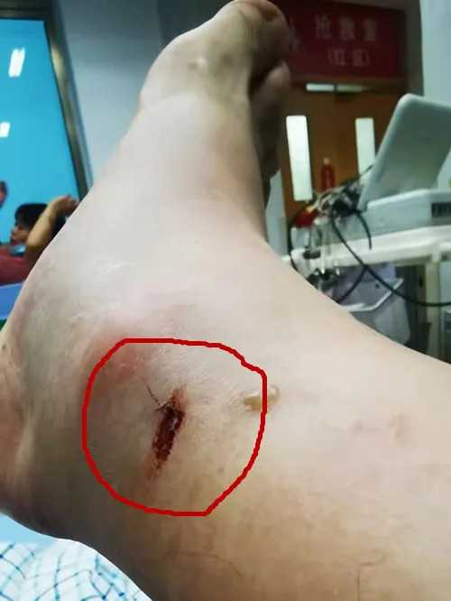 浙江男子散步时被剧毒蛇咬了一口,生死关头,教科书式操作自救成功_腾