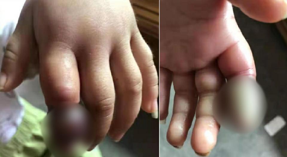 套在孩子的手指,脚趾上,会影响血液循环,导致手指/脚趾缺血发黑坏死