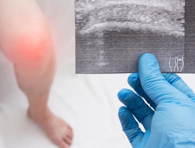 治标不治本,滑膜炎反复发作,可能是你的治疗方法选错了