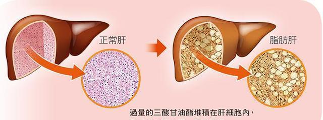 脂肪肝是怎么形成的轻度脂肪肝需要担心吗不妨听听医生的说法
