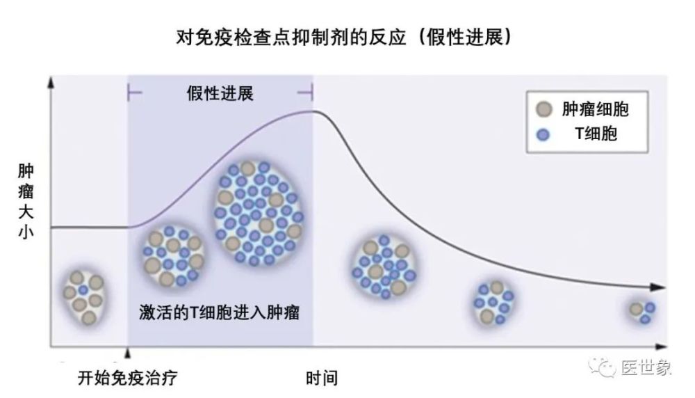 腫瘤免疫治療過程中的假性進展如何區分假性進展與真正進展