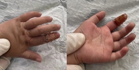 "静静的手指被勒时间太久,指神经受损,出院时感觉尚未恢复,回家后还