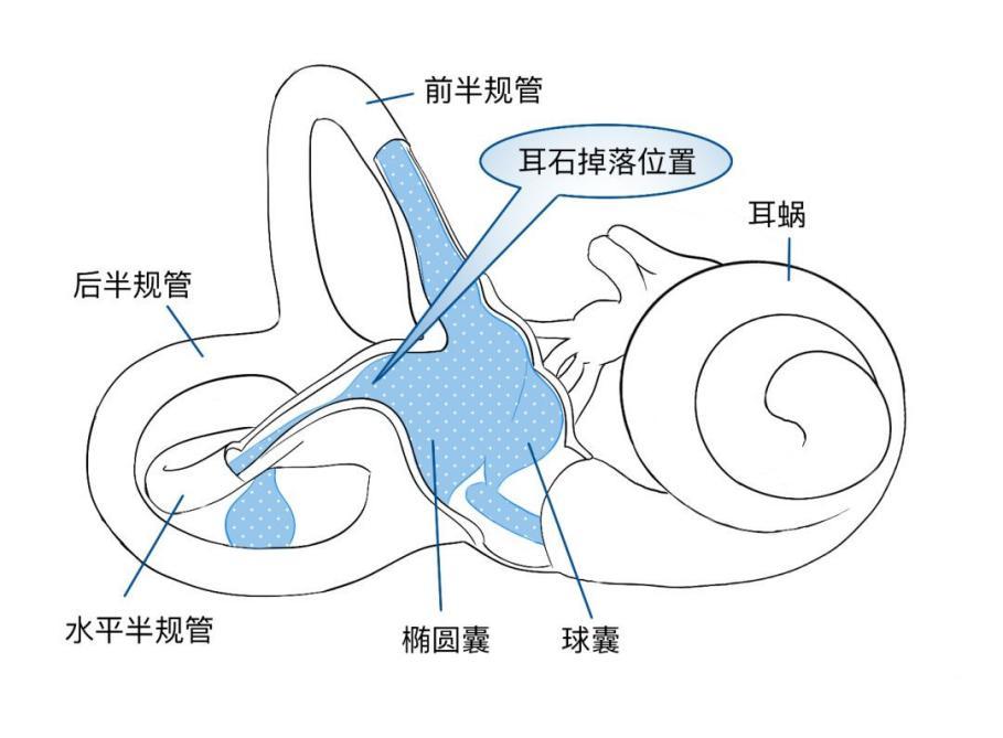 其实头晕也有可能是因为耳石症