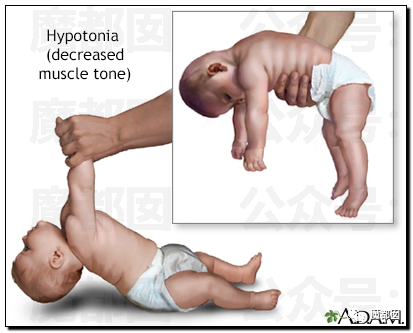 低张力及生长迟缓的症状门克斯综合症是一种极其罕见的遗传性疾病,大